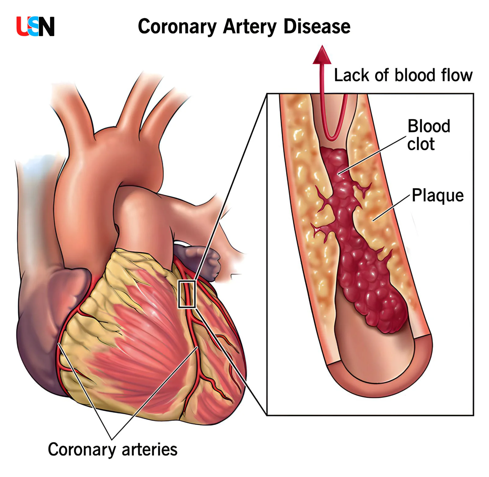 All About Coronary Artery Disease